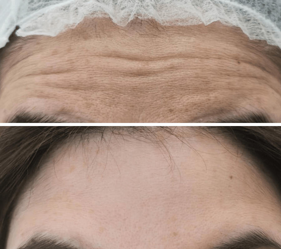 Wrinkles Before and After