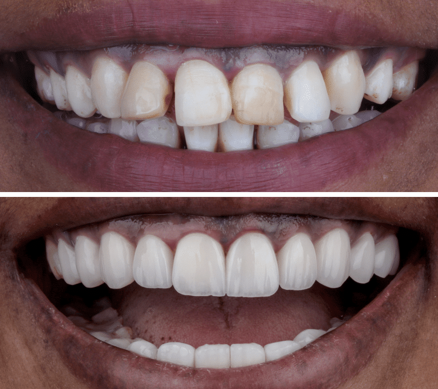 Hollywood Smile Before and After-3-min