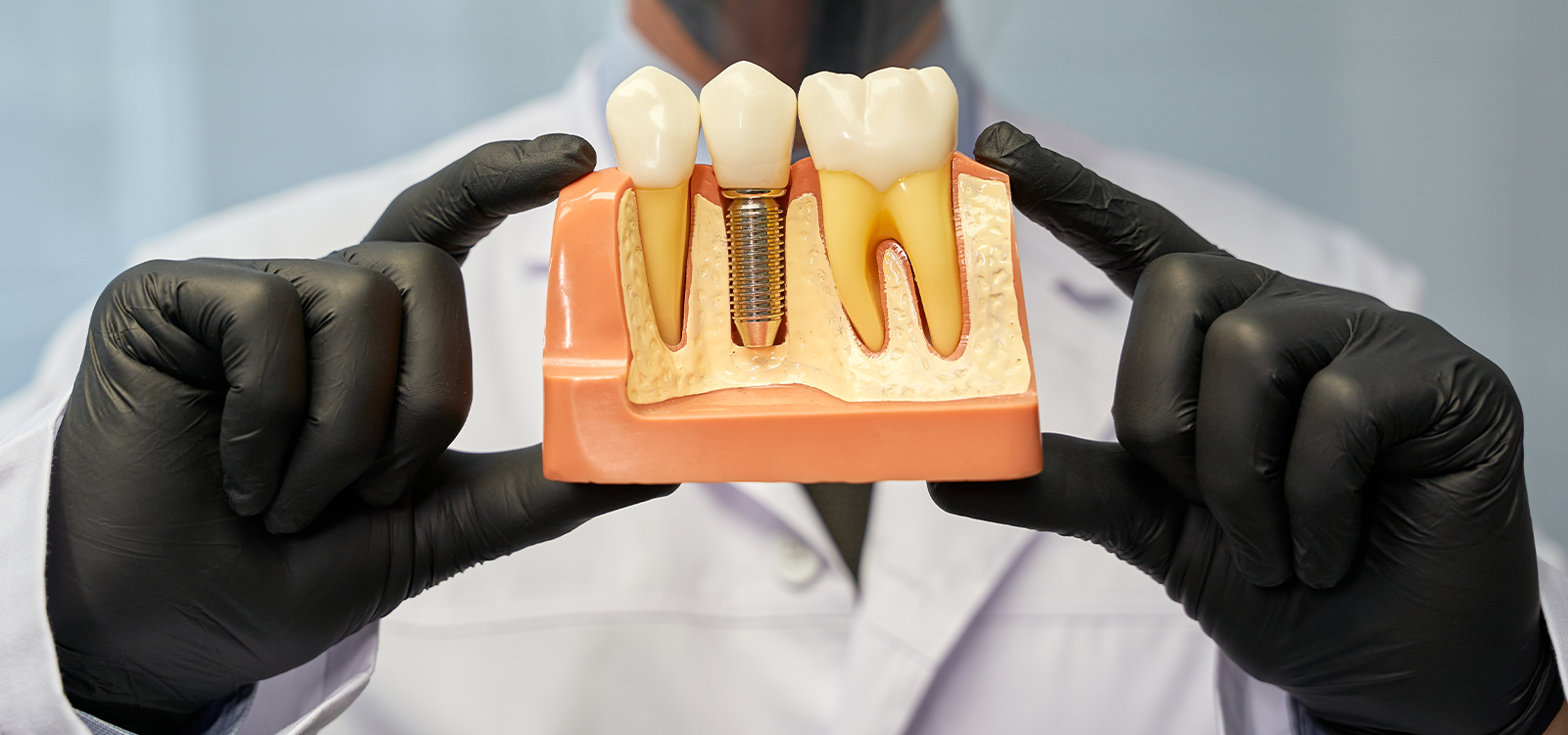 Can Dental Implants Cause Cancer? Myths vs. Facts