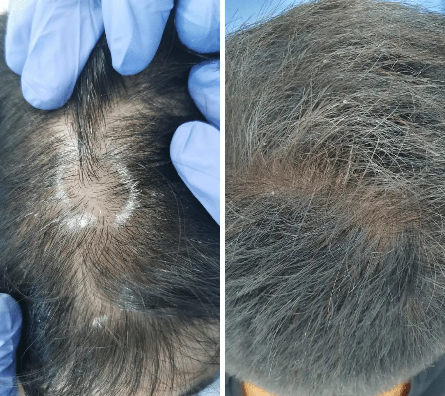 Mesotherapy-Before-and-After-3-min