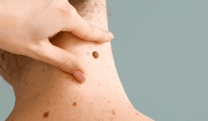 Mole Removal in Dubai (2025) – Safe & Effective Treatment