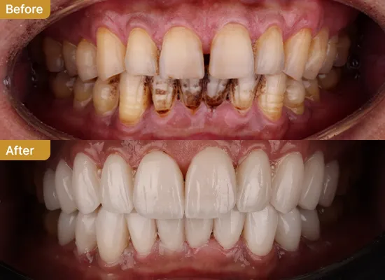 2BA_Dental Implant