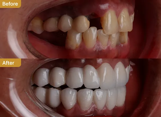 3BA_Dental Implant
