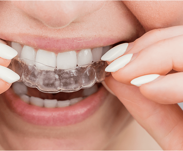 Invisalign Treatment in Dubai: How Aligners Fit into a Busy Lifestyle