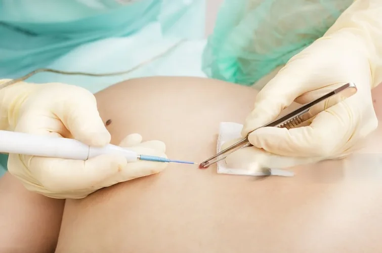 Mole Removal Procedure