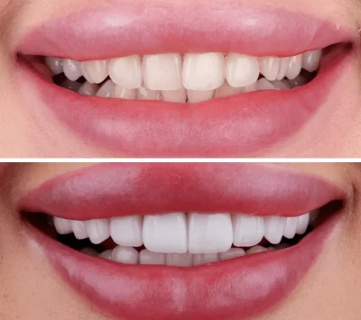 Close-up of a perfect smile enhanced with top-quality dental veneers in Dubai.